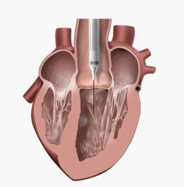 TAVR Step 1 TAVR Step 1