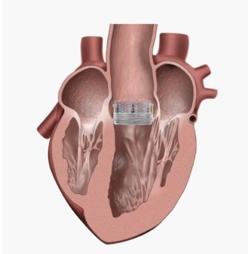 TAVR Step 3 TAVR Step 3