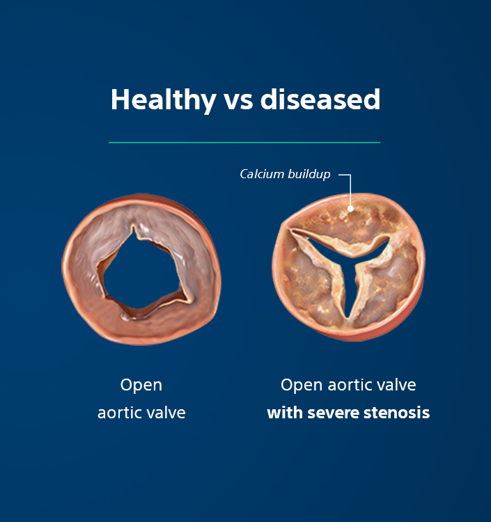 Healthy vs Diseased Aortic Valves